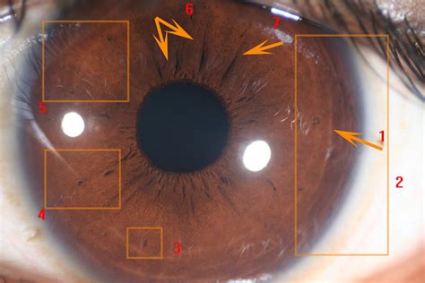 Nerve Rings Iridology Examples Images Iriscope Iridology Camera