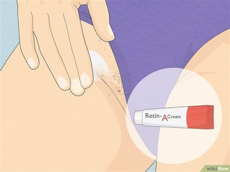 How To Get Rid Of Razor Bumps In The Bikini Area Easy Tips