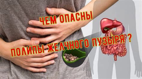 Полип желчного пузыря? Что делать? - YouTube