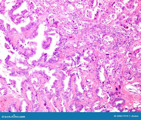 Mucinous Adenocarcinoma Of Stomach Illustration And Micrograph Royalty