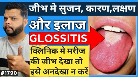 जीभ मे सूजन Glossitis Causes Types And Treatment In Hindi Youtube