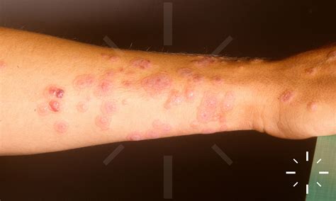 DermaCompass - Erythema exsudativum multiforme
