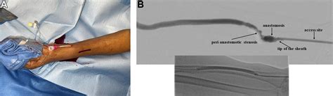 Av Fistula Radiocephalic