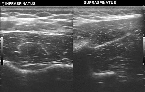 Radiopaedia Case Subscapularis Tendon Tear Preoperative And