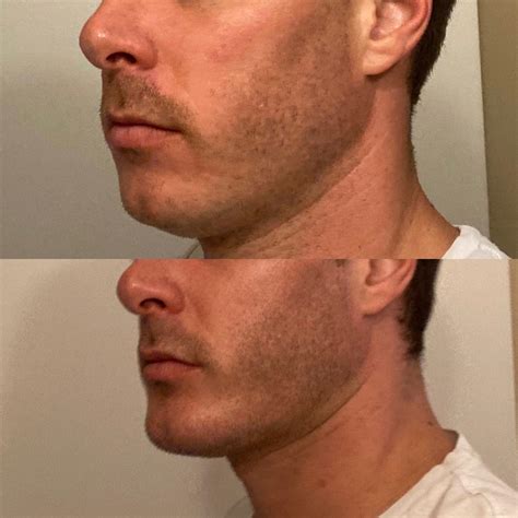 Insecure About My Weak Jawline Chin Especially When I Speak Any