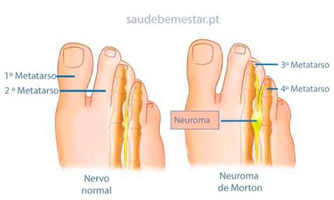 Neuroma De Morton O Que Causas Sintomas Tratamento Cirurgia Em