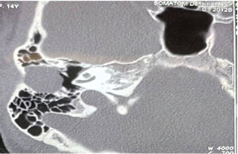 Scielo Brasil External Auditory Canal Cholesteatoma Clinical And Radiological Features