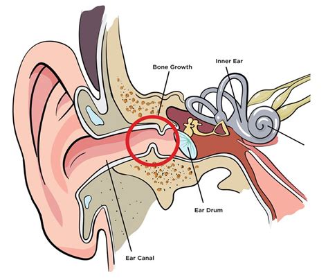 Hydro Surf Shop Blog What Is Exostosis Surfers Ear