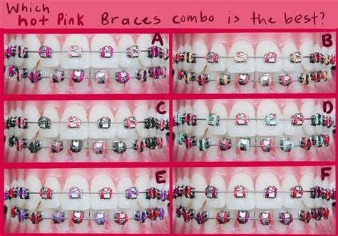Light Pink Braces