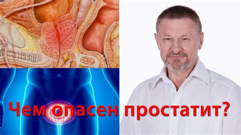Чем опасен простатит? - YouTube