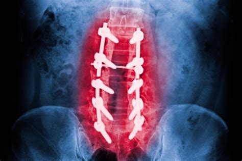 Pedicle Eremedium