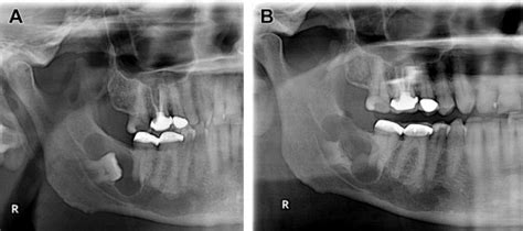 Coronectomy - Oral and Maxillofacial Surgery Clinics