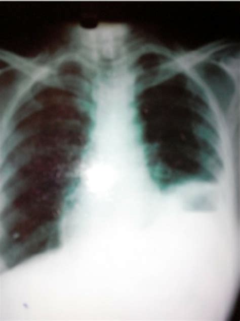 Chest X Ray Case 1 Download Scientific Diagram