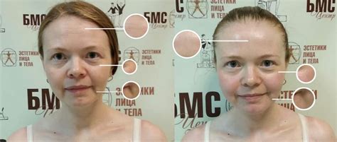 Биомеханическая стимуляция (БМС) лица | Санкт-Петербург, Центр «Элит»