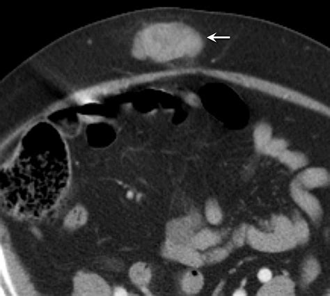 Soft Tissue Masses In The Abdominal Wall Clinical Radiology