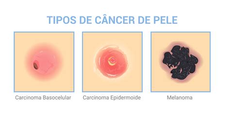 Quais são as causas e os sintomas do câncer de pele