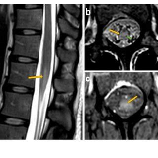 Magnetic Resonance Imaging Of The Lumbosacral Spine Sagittal A And