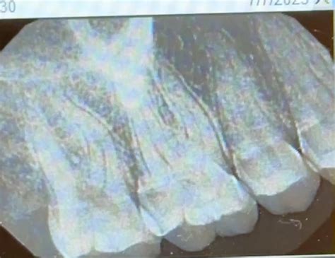how to drain a gum abscess at home 7