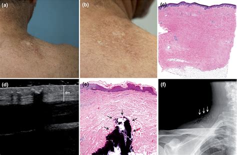 Morphea Histopathology