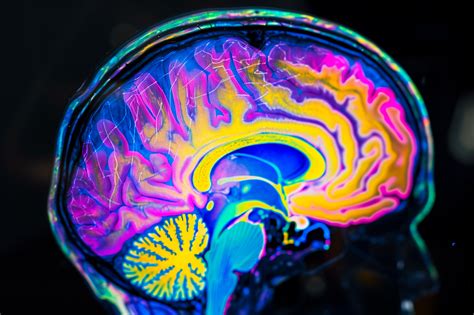 Autism Severity Linked To Brain Overgrowth Research Shows