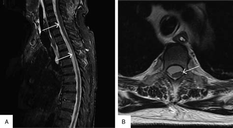 Spinal Epidural Hematoma Mri Acute Spontaneous Spinal Epidural