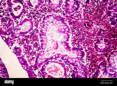 Villous Colon Adenocarcinoma Light Micrograph Photo Under Microscope