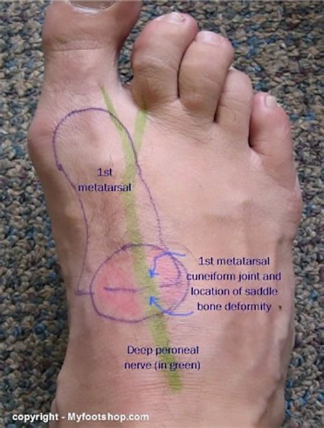 Saddle Bone Deformity | Causes and treatment options - Printer friendly ...