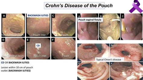 Ulcerative Colitis Complications Management Ppt