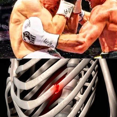 Fisura De Costilla Tiempo De Recuperaci N Hot Sale Varsana