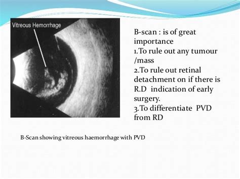 Vitreous Hemorrhage