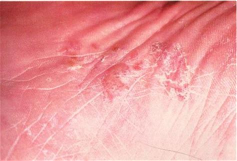 Микоз:причины, симптомы, лечение микоза