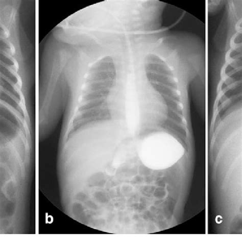 A Segment Of Ileal Volvulus Was Seen 2 Cm Proximal To Ileocecal Valve