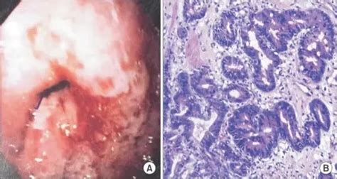 What Is A Gastric Adenocarcinoma Pathosomes