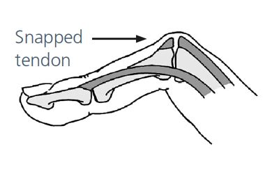 Advice And Exercises Following Your Central Slip Injury South Tees