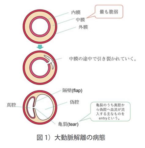 大動脈解離について① 「大動脈解離とは？」 関西ろうさい病院（兵庫県尼崎市）地域医療支援病院・がん診療連携拠点病院