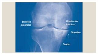 Osteoartritis En El Adulto Mayor Ppt Descarga Gratuita