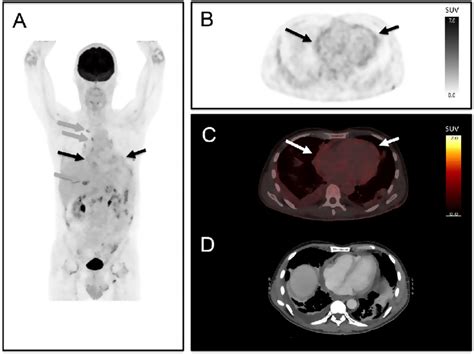 A Maximum Intensity Projection Mip Image Of The Patient Black