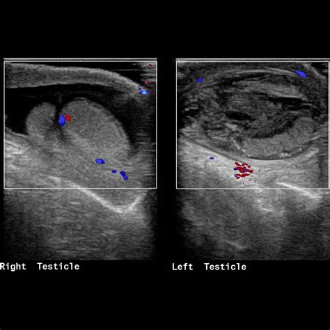 Baby Swollen Above Testicles at Clara Moran blog