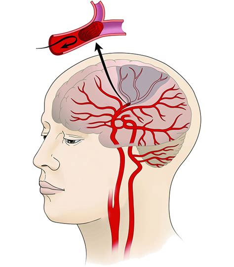 Stroke Mental Standard Operating Procedures Stroke Mental Health