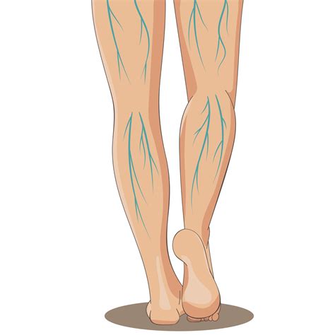 Varicosity. Female legs, back view, with varicose veins 3716537 Vector