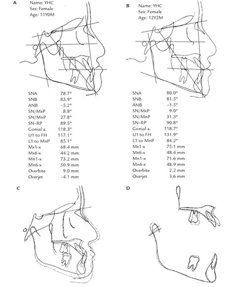 Wits Cephalometric Analysis Nonligov