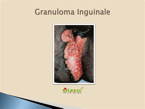 PPT - Granuloma Inguinale PowerPoint Presentation, free download - ID