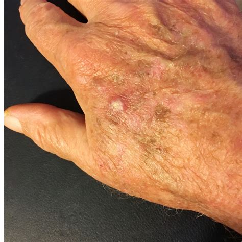 Actinic Keratoses Skin Health Institute