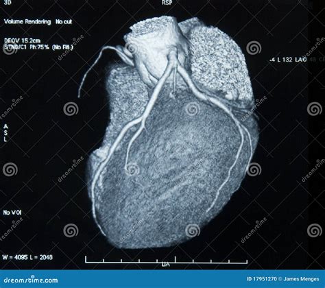 CT-Scan Heart stock photo. Image of negative, scan, heart - 17951270