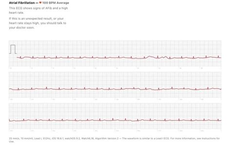 ECG AFIB? : r/AFIB