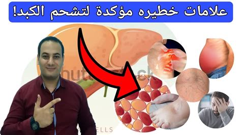 تنظيف سموم الكبد الدهنيلعلاج تشحم الكبد واعراضه بدون ادويه 9 علامات