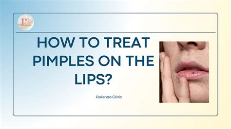 How To Treat Pimples On The Lips Rakshaaclinic Medium