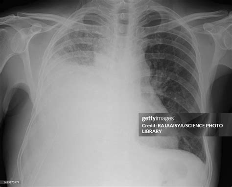 Pleural Effusion Xray High-Res Stock Photo - Getty Images