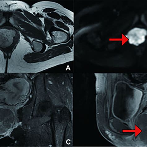 Primary Treatment Magnetic Resonance Imaging Mri Scans A Mass On