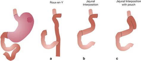 Methods Of Reconstruction—bi Bii Roux En Y Jejunal Interposition